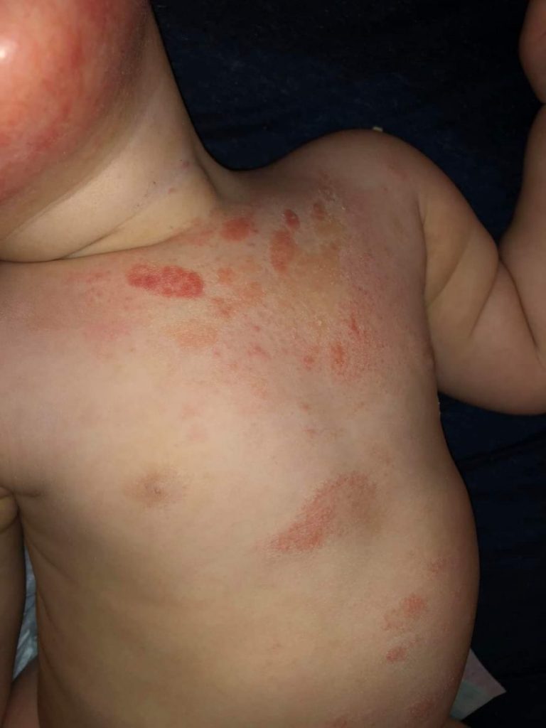 Greșeli pe care le fac părinții în alergiile alimentare la bebeluși