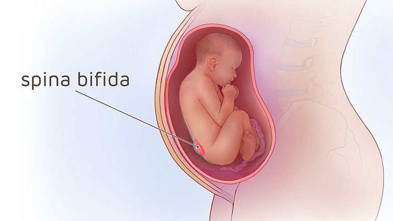 https://www.chop.edu/health-resources/spina-bifida-surgery-during-pregnancy-illustrations
